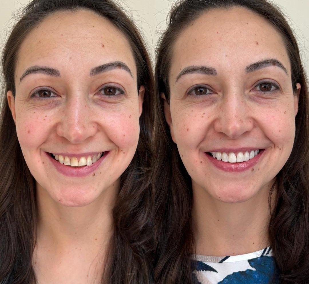 Faceta em resina, antes e depois